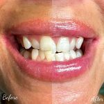 Tooth Whitening Can Enhance Your Appearance
